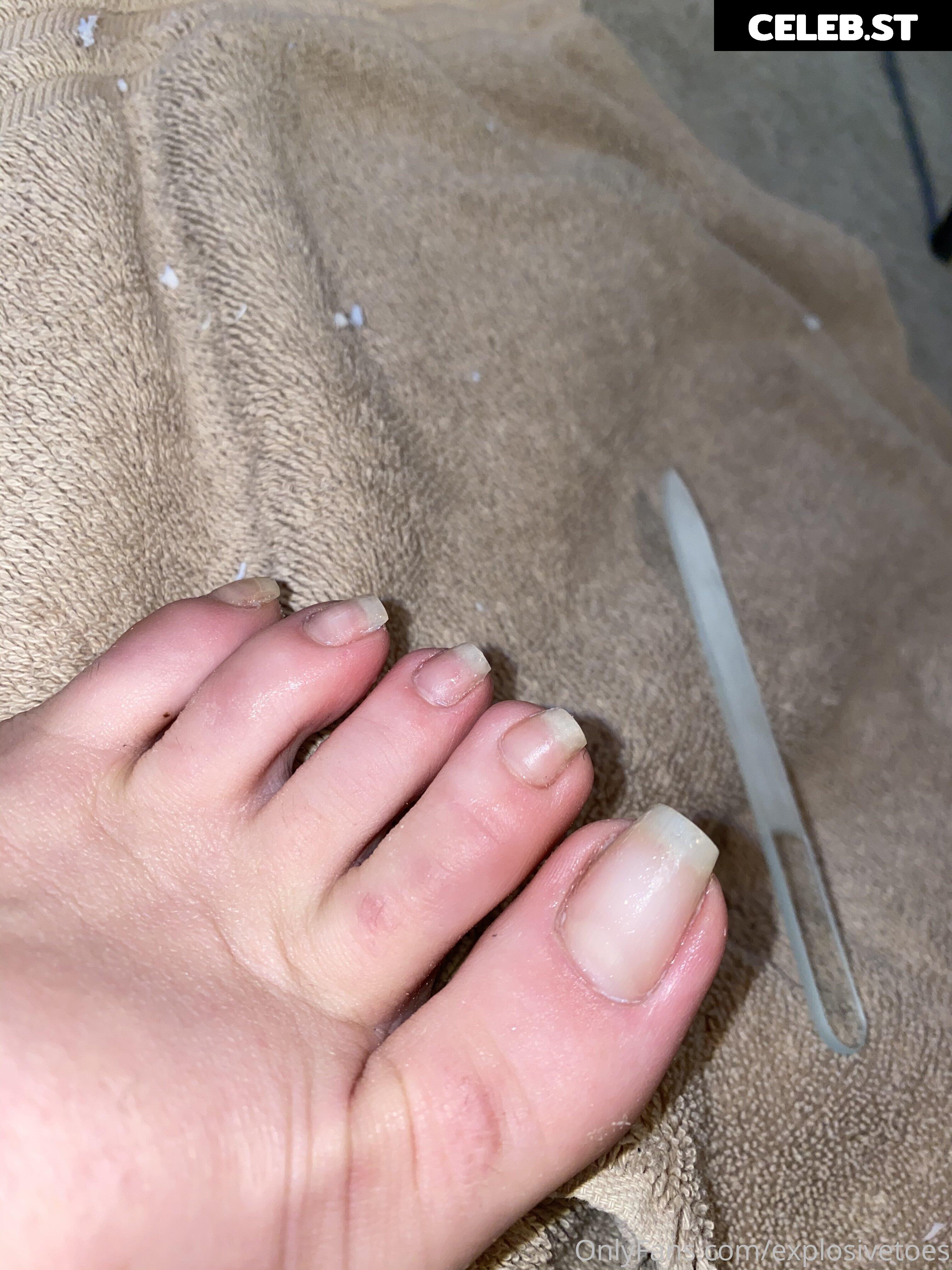 explosivetoess Image 17768210