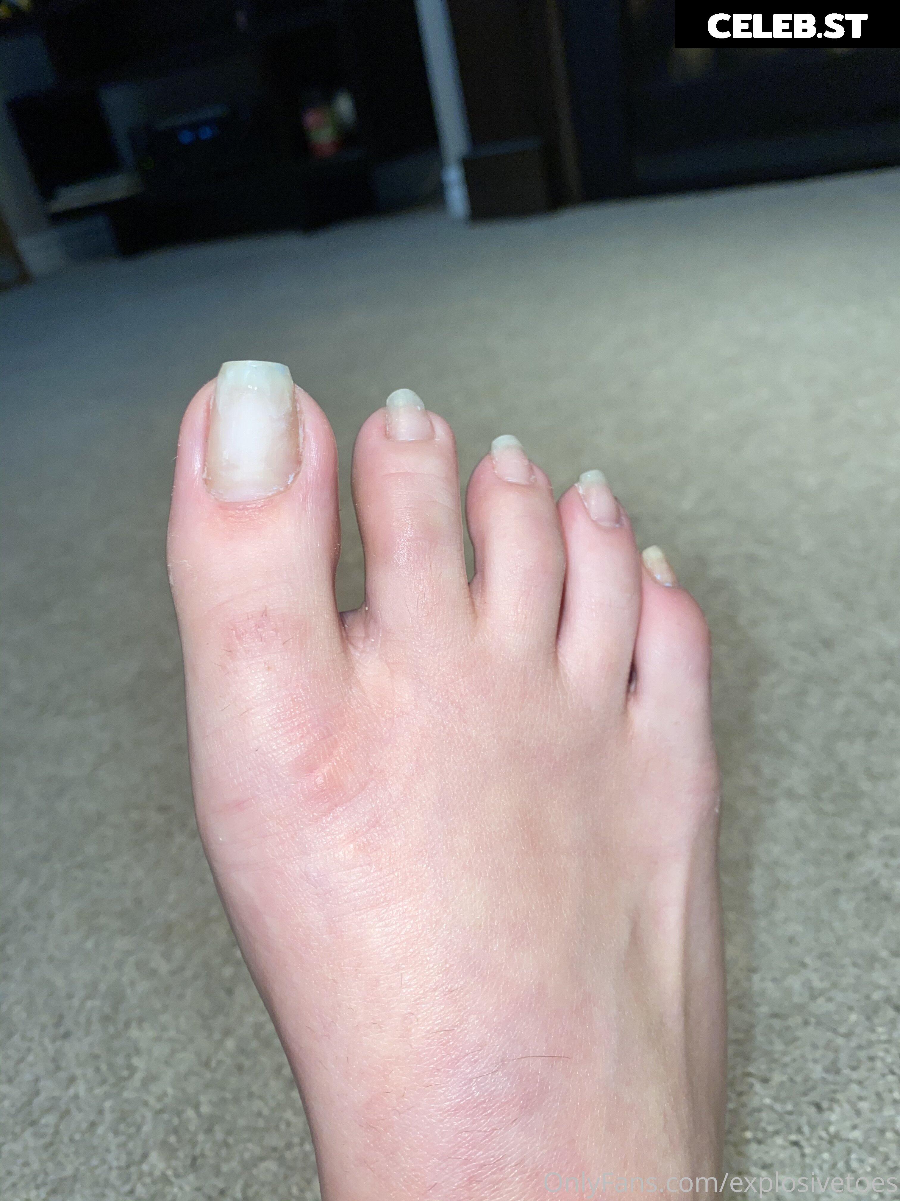 explosivetoess Image 17768214