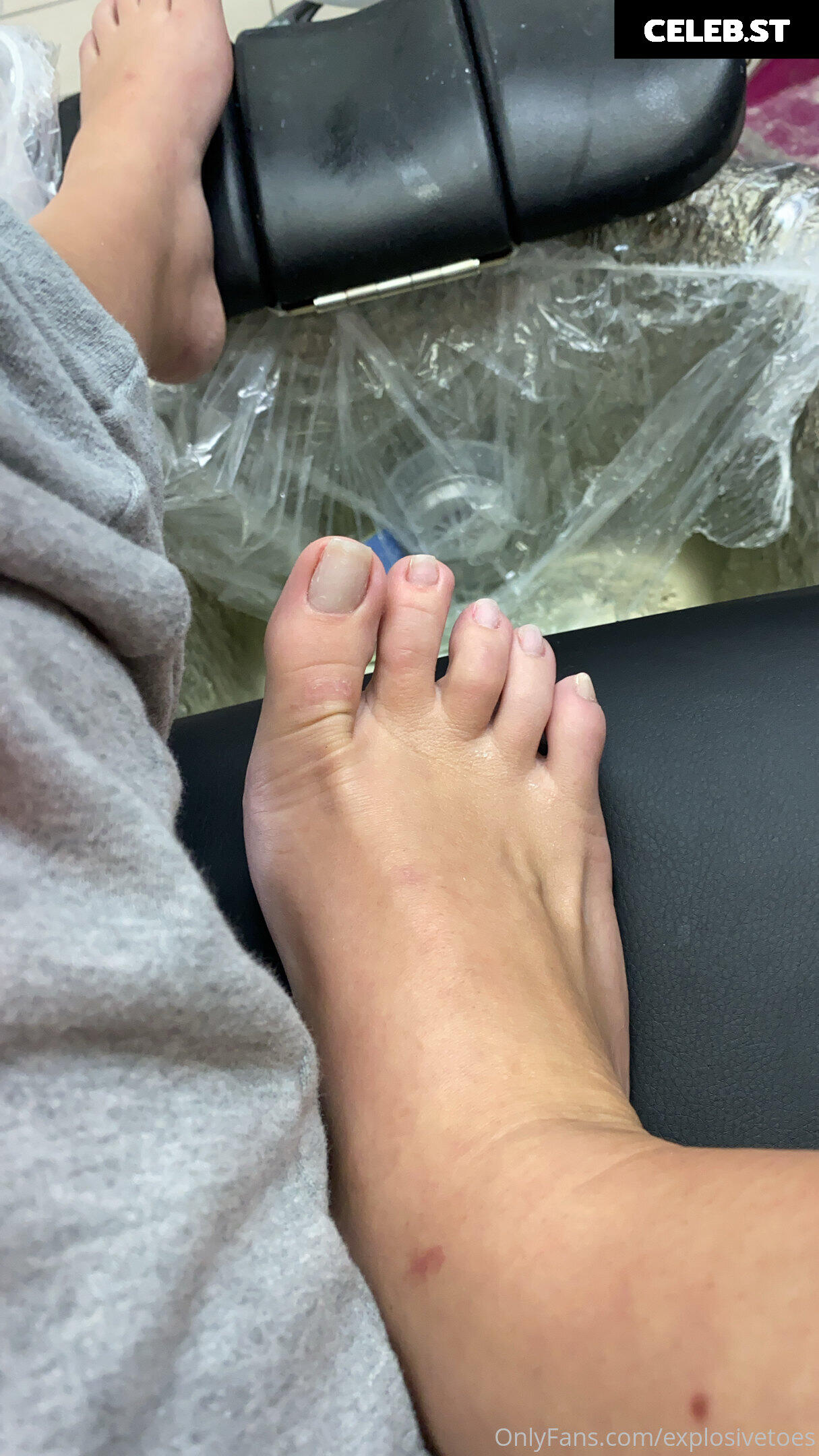 explosivetoess Image 17778034