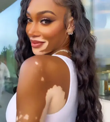 Image 1731892 from Winnie Harlow