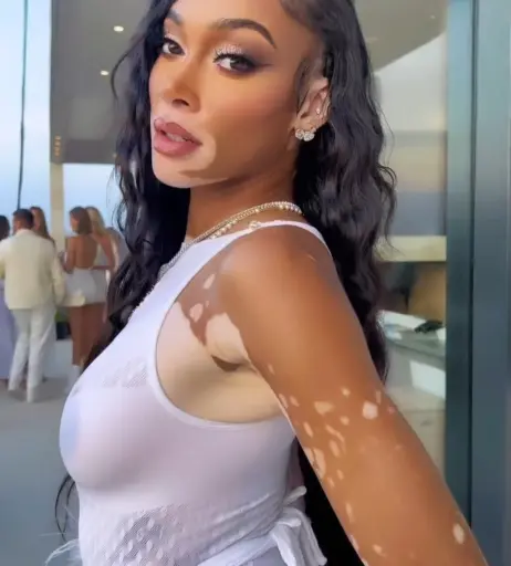 Image 1731978 from Winnie Harlow