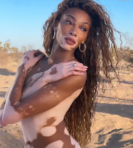 Image 1732426 from Winnie Harlow