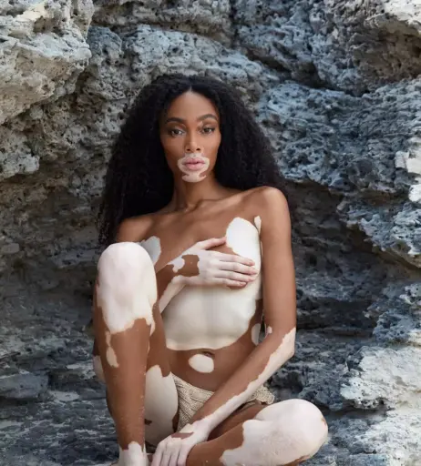 Image 1729472 from Winnie Harlow