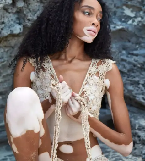 Image 1729411 from Winnie Harlow
