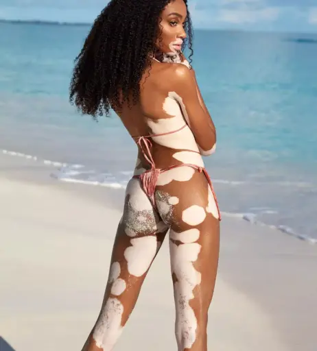Image 1729996 from Winnie Harlow
